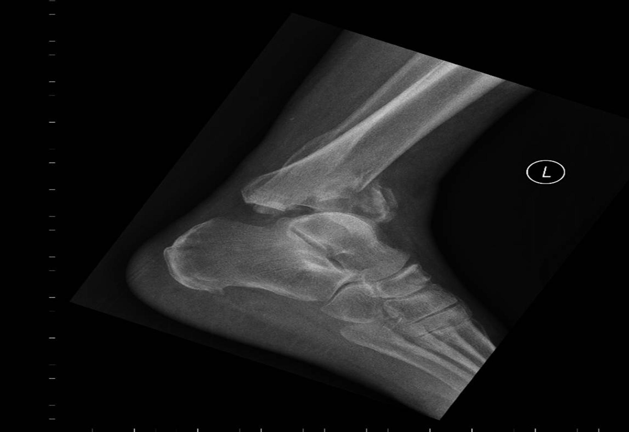 Ankle Arthrodesis Foot & Ankle Orthobullets